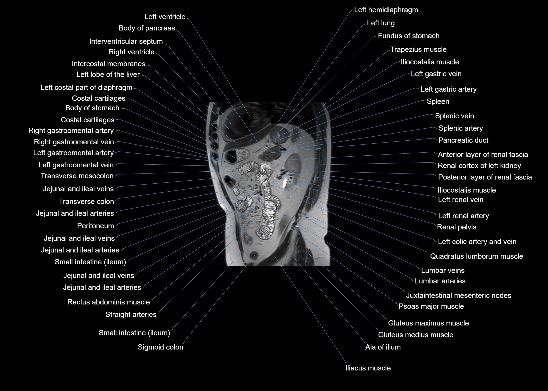 MRI abdomen sagittal cross sectional anatomy  radiology  image-img-00001-00047.webp